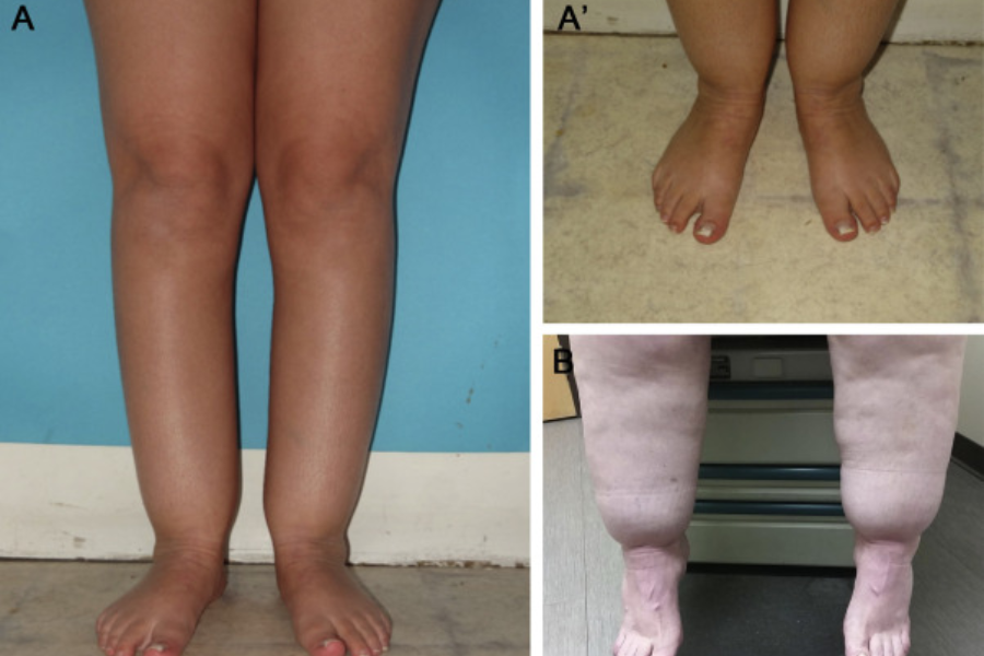 What Is Lipedema?